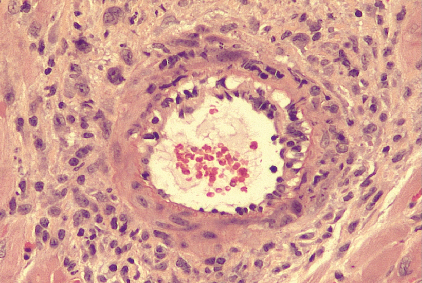 Mouse heart transplant; CTLA4-Ig