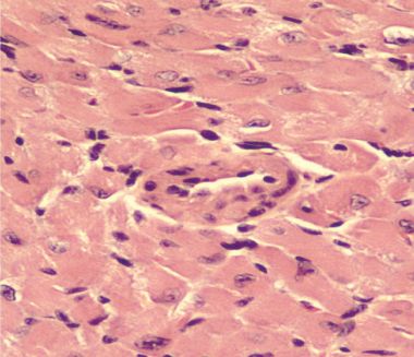 Mouse heart transplant; CTLA4-Ig and immunoproteasome inhibitor DPLG3 Mouse heart transplant; CTLA4-Ig and immunoproteasome inhibitor DPLG3