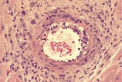 Mouse heart transplant; CTLA4-Ig